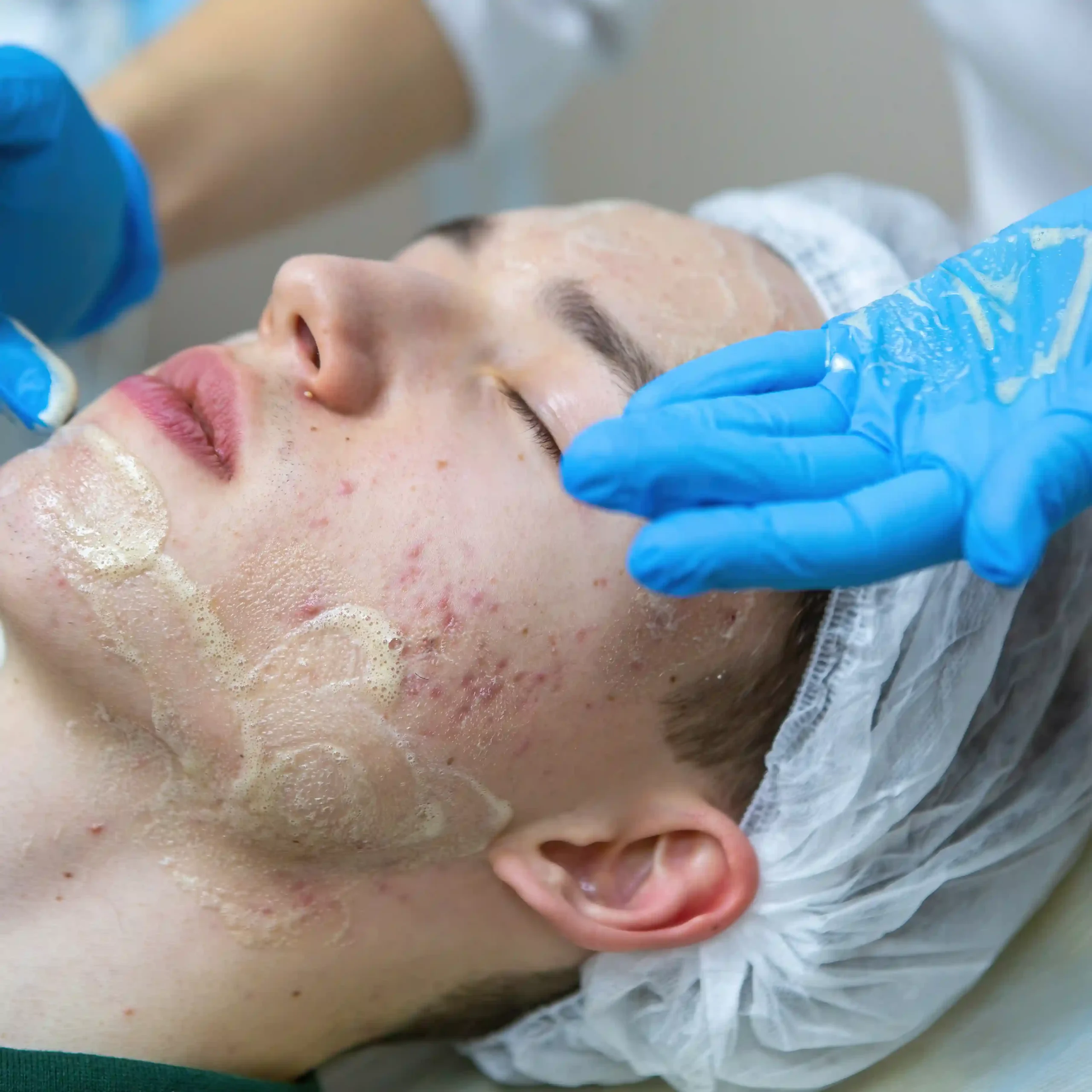 DolphinMed Polikliniği profesyonel Akne ve Skar Bakımı süreci ve doku onarımı.