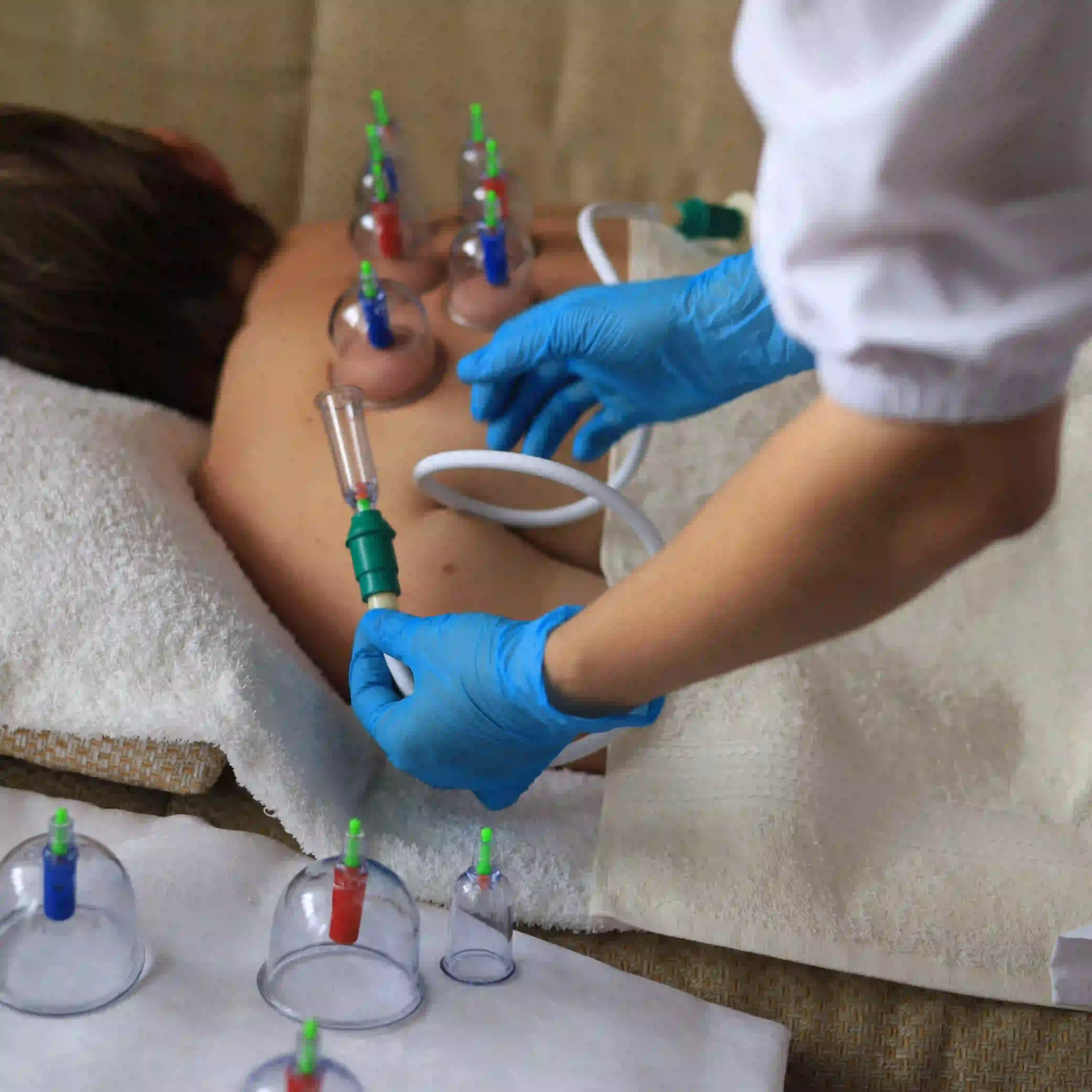 DolphinMed Polikliniği uzman doktor denetiminde ve steril ortamda gerçekleştirilen tıbbi Hacamat (Kupa Terapisi) uygulaması.