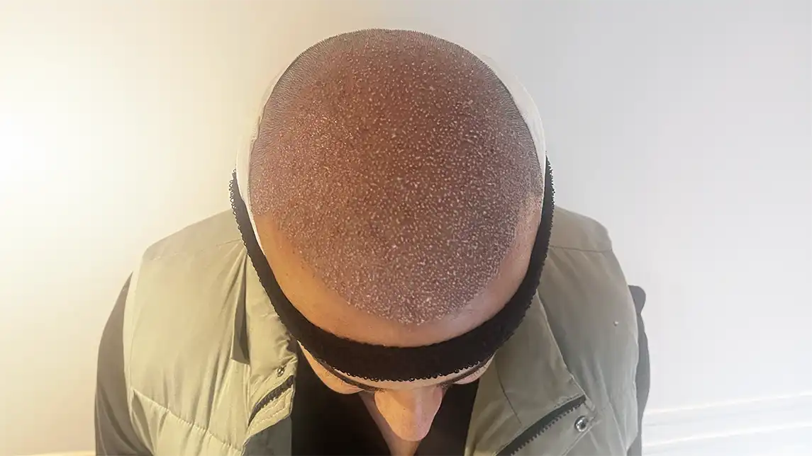 Saç ekimi için doğru zaman ve mevsimsel analiz aşamaları.